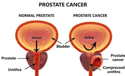 Prostate Cancer Cure And Remedy