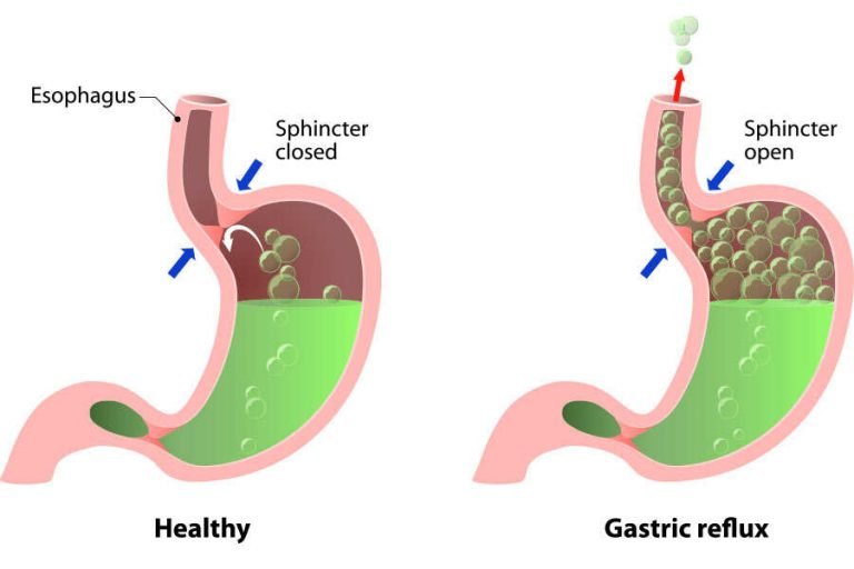 How To Cure Acid Reflux, Ulcer - How To Cure Acid Reflux, Ulcer